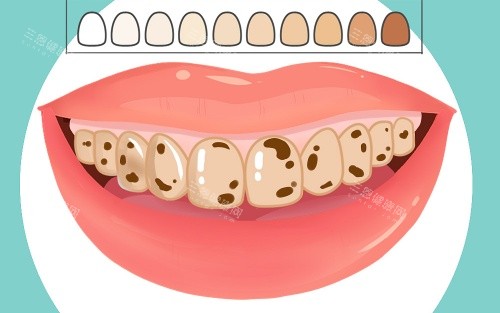 牙齿比色示意图 牙齿比色示意图