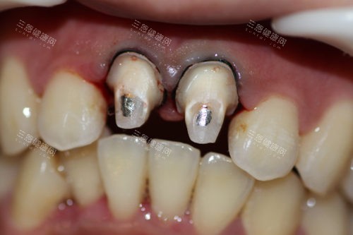 牙齿打桩修复