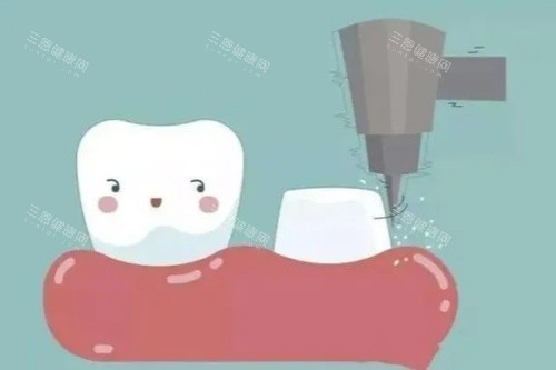 牙齿打桩卡通图