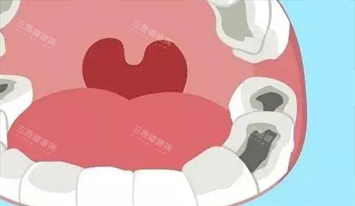 口腔牙齿龋齿动画展示情况