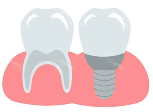种植牙和牙齿图