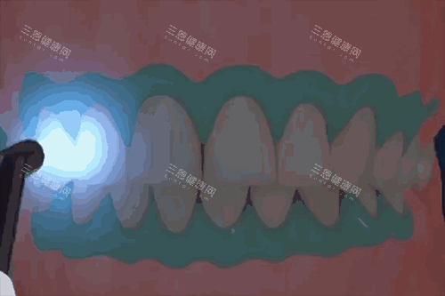 美白牙齿示意图