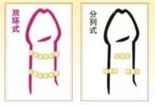 阴茎入珠术款式有哪些