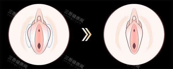 阴唇一长一短改善图片