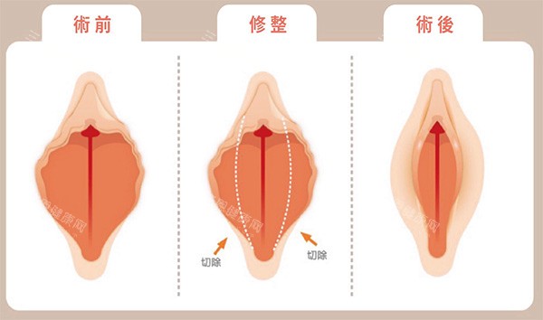 外阴唇切除术前术后