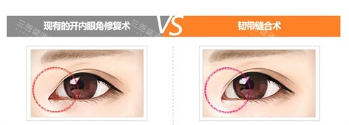 内眼角修复两种手术对比