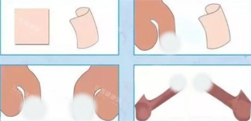 阴茎生物补片手术前后对比 阴茎生物补片手术前后对比