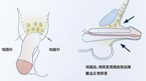 吸脂增大阴茎照片 吸脂增大阴茎照片