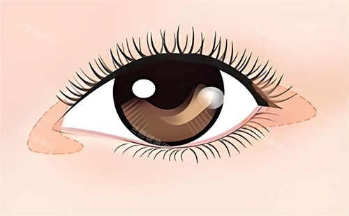 外眼角露红还能修复吗？开完外眼角有缺口不愈合该怎么办？皮肤科医师解答~