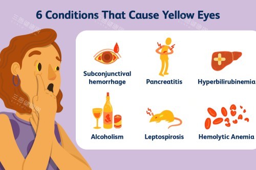 造成眼睛发黄的原因 造成眼睛发黄的原因