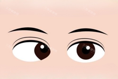 眼睛斜视卡通图 眼睛斜视卡通图