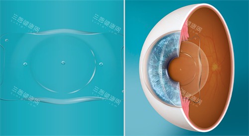 人工晶体植入眼睛演示图展示