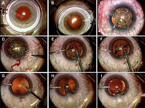 永州市第一人民医院眼科收费价格表查看，近视矫正13000起/白内障5000起！