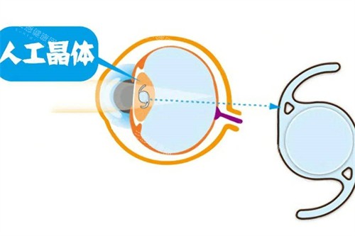 白内障晶体植入 白内障晶体植入