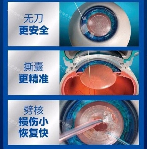 飞秒激光治疗白内障手术图 飞秒激光治疗白内障手术图