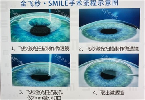 临沂华厦眼科全飞秒手术过程图解 临沂华厦眼科全飞秒手术过程图解