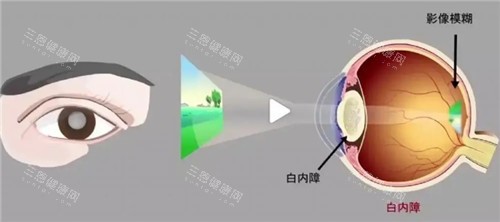 白内障视力表现图 白内障视力表现图