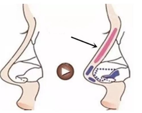 分段式隆鼻示意图 分段式隆鼻示意图