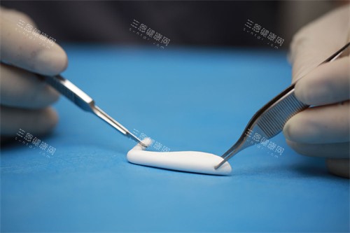 隆鼻手术中使用的膨体 隆鼻手术中使用的膨体