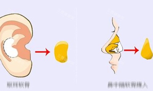 耳软骨隆鼻动画示意图 耳软骨隆鼻动画示意图