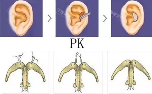耳软骨支架隆鼻图 耳软骨支架隆鼻图
