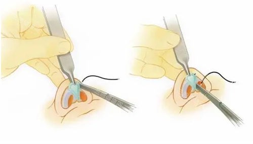 隆鼻手术鼻头过程展示图 隆鼻手术鼻头过程展示图