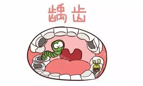 牙齿龋齿示意图