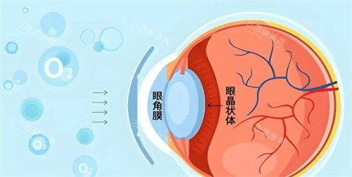 角膜塑形镜佩戴方法