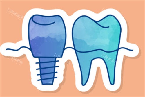种植牙和正常牙齿