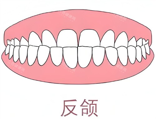 牙齿反颌卡通示意图