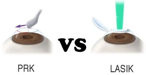 PRK近视手术对比LASIK近视手术漫画图 PRK近视手术对比LASIK近视手术漫画图