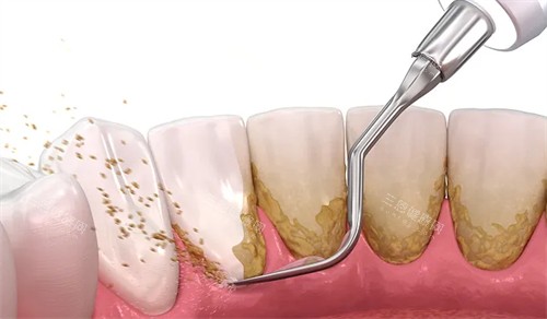 洗牙可改善牙齿污渍 洗牙可改善牙齿污渍