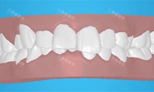 牙齿深覆合卡通图 牙齿深覆合卡通图