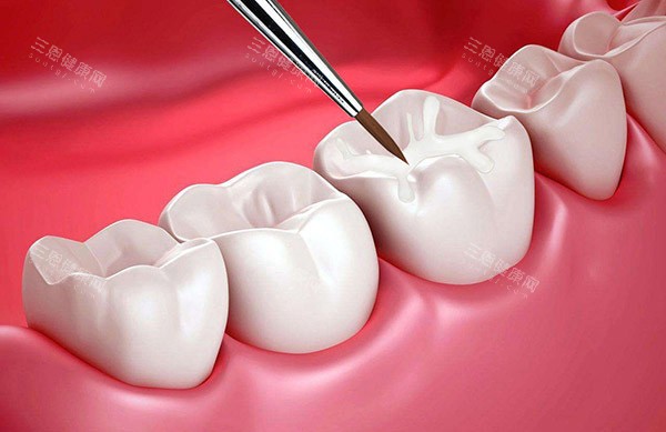 窝沟封闭保护牙齿 窝沟封闭保护牙齿