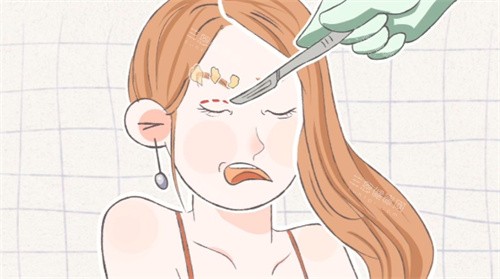 双眼皮手术失败修复卡通图片