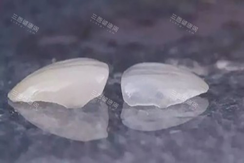 树脂和全瓷贴片实物示意图 树脂和全瓷贴片实物示意图