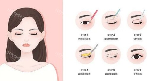 拉双眼皮手术示意图 拉双眼皮手术示意图