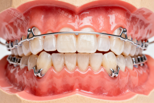 牙齿保持器模型一览 牙齿保持器模型一览