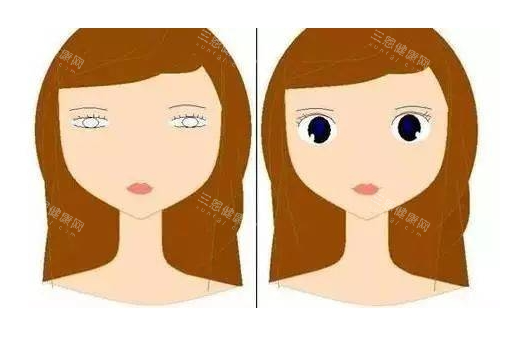 眼皮松弛做双眼皮对比图