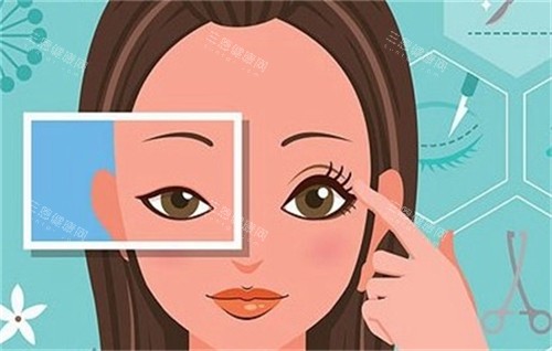 双眼皮手术前后对比