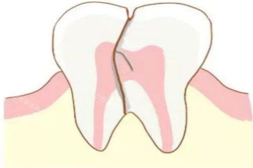 牙齿隐裂卡通图 牙齿隐裂卡通图