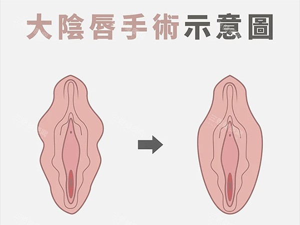 大阴唇整形前后照片 大阴唇整形前后照片