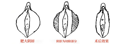 小阴唇肥大直接切除法演示动画图 小阴唇肥大直接切除法演示动画图