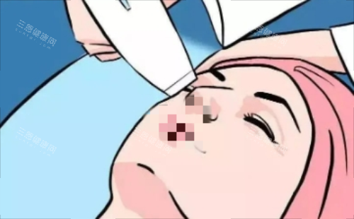 激光除皱示意图