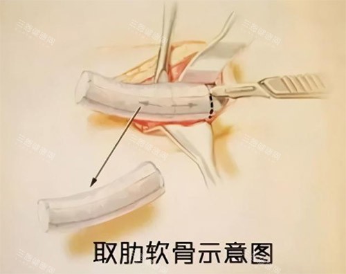 肋骨鼻手术过程图
