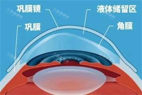 巩膜镜结构图 巩膜镜结构图