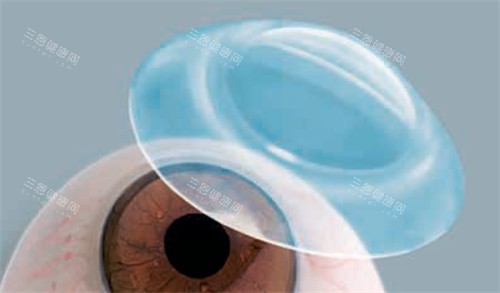 巩膜镜展示图 巩膜镜展示图