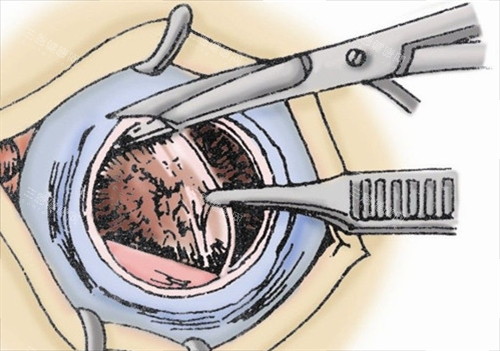眼角膜割除动画展示 眼角膜割除动画展示