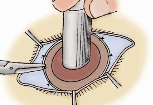 眼角膜移植手术操作展示 眼角膜移植手术操作展示