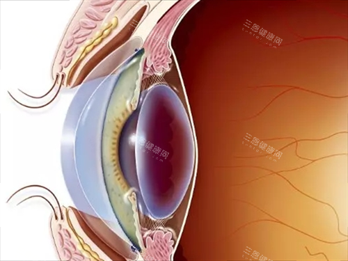 割眼角膜手术眼部侧面透视图 割眼角膜手术眼部侧面透视图